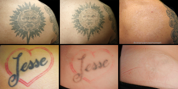 Long Island Med Spa Offers Improved Tattoo Removal with PiQo4 Laser  Deep  Blue Med Spa