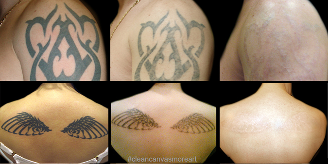 Finding the right laser tattoo removal clinic in Long Island 